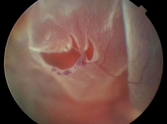 Síntomas que revelan que tienes problemas en la retina Síntomas que revelan que tienes problemas en la retina
