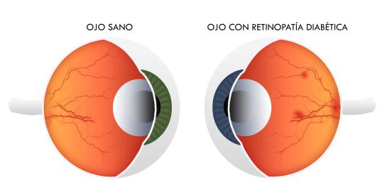 Síntomas que revelan que tienes problemas en la retina Síntomas que revelan que tienes problemas en la retina