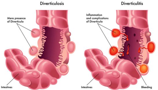 Sistema digestivo, medicina, salud, bienestar.: Divertículos: Cuándo medicina, cuándo cirugía Sistema digestivo, medicina, salud, bienestar.: Divertículos: Cuándo medicina, cuándo cirugía