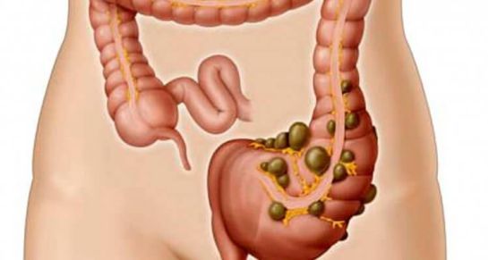 Sistema digestivo, medicina, salud, bienestar.: Divertículos: Cuándo medicina, cuándo cirugía Sistema digestivo, medicina, salud, bienestar.: Divertículos: Cuándo medicina, cuándo cirugía
