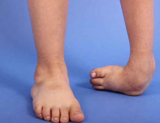 BBmundo: ¿Qué es el pie equinovaro? BBmundo: ¿Qué es el pie equinovaro?