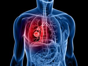 Cuídate del cáncer de pulmón Cuídate del cáncer de pulmón