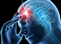 Conoce el nuevo tratamiento contra la migraña