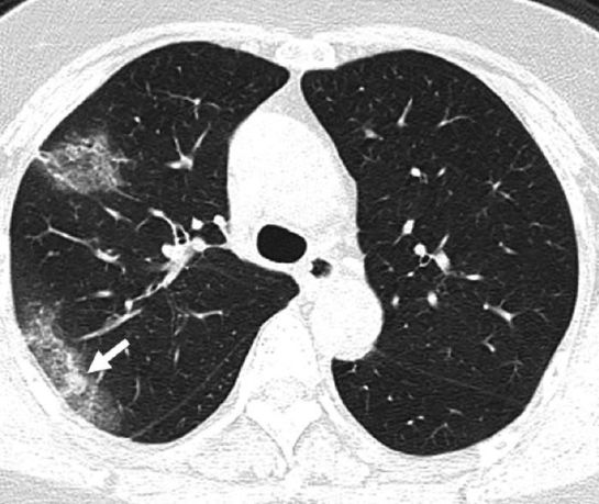 ¿Qué hace el coronavirus con nuestro cuerpo? ¿Qué hace el coronavirus con nuestro cuerpo?