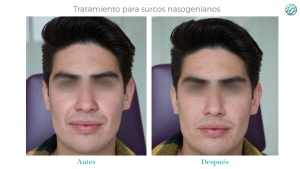 Rostro joven y sin bisturí Rostro joven y sin bisturí