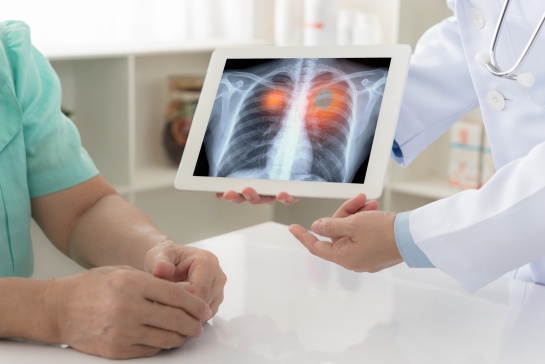 Día Internacional del Cáncer de Pulmón Día Internacional del Cáncer de Pulmón