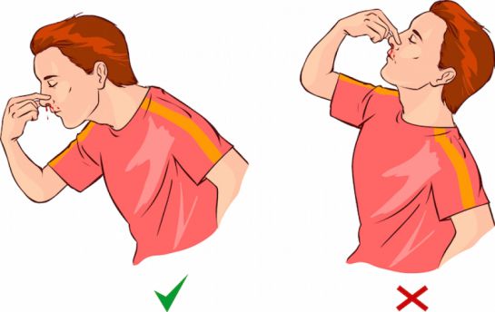 ¿Qué hacer en caso de una hemorragia nasal? ¿Qué hacer en caso de una hemorragia nasal?