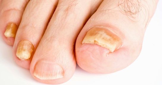 Las uñas revelan trastornos de salud Las uñas revelan trastornos de salud