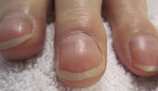 Las uñas revelan trastornos de salud Las uñas revelan trastornos de salud