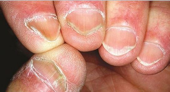 Las uñas revelan trastornos de salud Las uñas revelan trastornos de salud