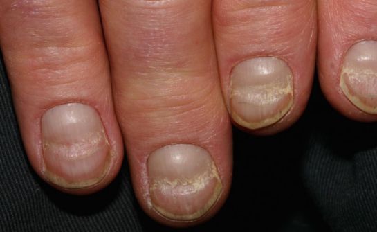 Las uñas revelan trastornos de salud Las uñas revelan trastornos de salud