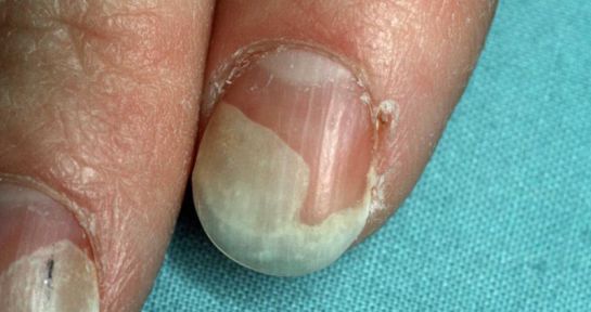 Las uñas revelan trastornos de salud Las uñas revelan trastornos de salud