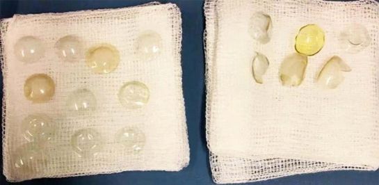 Encuentran 27 lentes de contacto en el ojo de una paciente de 67 años Encuentran 27 lentes de contacto en el ojo de una paciente de 67 años
