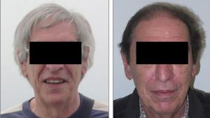 Tratamiento experimental para cáncer devuelve color negro o marrón al cabello canoso de pacientes Tratamiento experimental para cáncer devuelve color negro o marrón al cabello canoso de pacientes