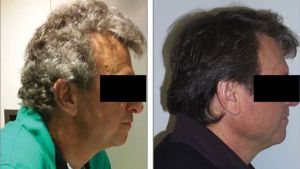Tratamiento experimental para cáncer devuelve color negro o marrón al cabello canoso de pacientes Tratamiento experimental para cáncer devuelve color negro o marrón al cabello canoso de pacientes