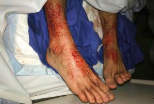 Piojos marinos atacan los pies de un joven australiano Piojos marinos atacan los pies de un joven australiano