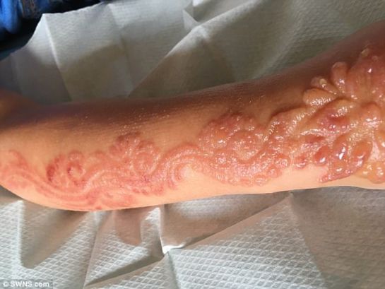 Niña de 7 años sufre quemaduras luego de aplicarse un tatuaje temporal de henna Niña de 7 años sufre quemaduras luego de aplicarse un tatuaje temporal de henna