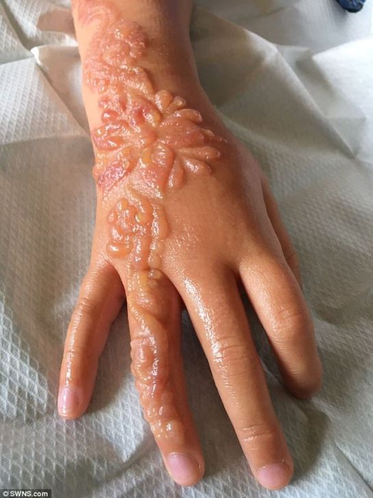 Niña de 7 años sufre quemaduras luego de aplicarse un tatuaje temporal de henna Niña de 7 años sufre quemaduras luego de aplicarse un tatuaje temporal de henna