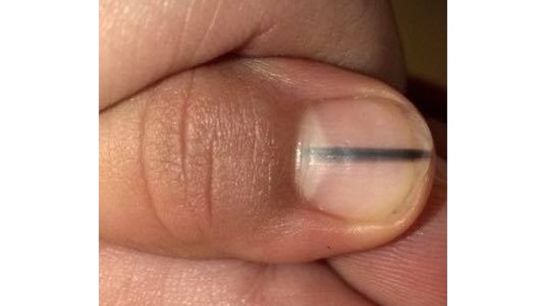 Manicurista descubre melanoma en la uña de una clienta Manicurista descubre melanoma en la uña de una clienta