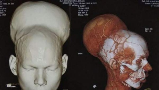 Tumor Cerebral: Extirpan el tumor cerebral más grande del mundo Tumor Cerebral: Extirpan el tumor cerebral más grande del mundo