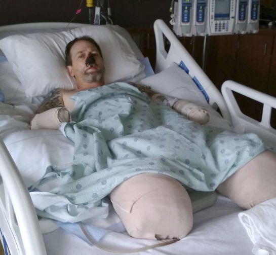 Le amputan las piernas y manos porque un perro lo lamió Le amputan las piernas y manos porque un perro lo lamió
