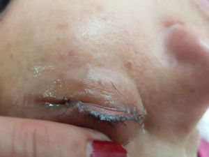 Unas extensiones de pestañas terminó por cerrarle los ojos Unas extensiones de pestañas terminó por cerrarle los ojos
