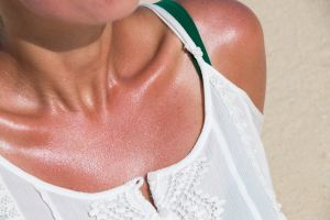 ¿Cómo cuidar la piel del sol? ¿Cómo cuidar la piel del sol?