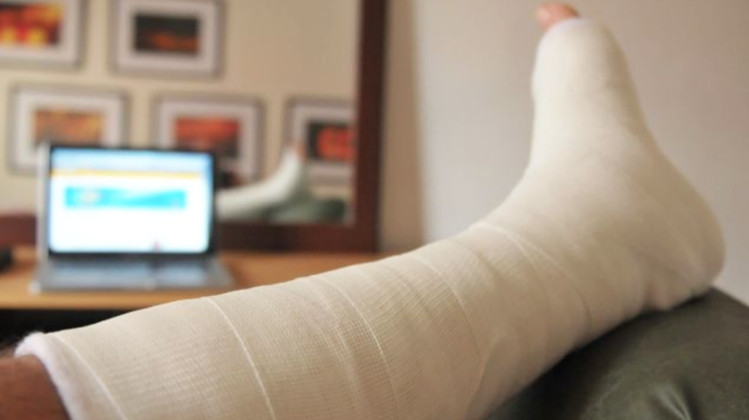 Férulas de yeso ortopédico por impresión 3D el sustituto para fracturas