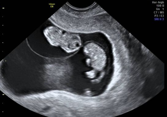 Nuevo caso de mellizos por superfecundación heteropaternal en China, ultrasonido Nuevo caso de mellizos por superfecundación heteropaternal en China, ultrasonido