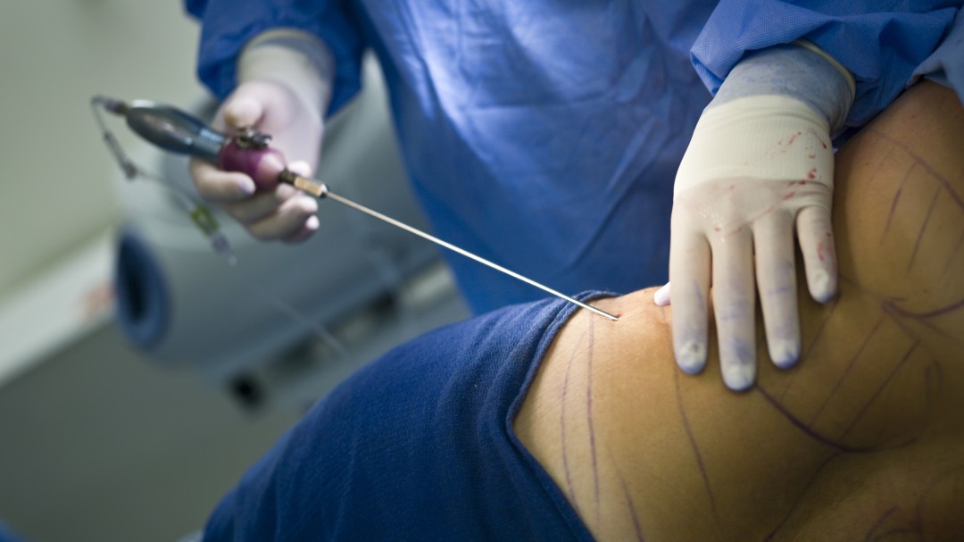 Mujer sale sin vida por liposucción