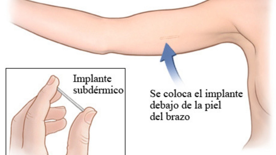 Anuncian campaña de colocación de anticonceptivos