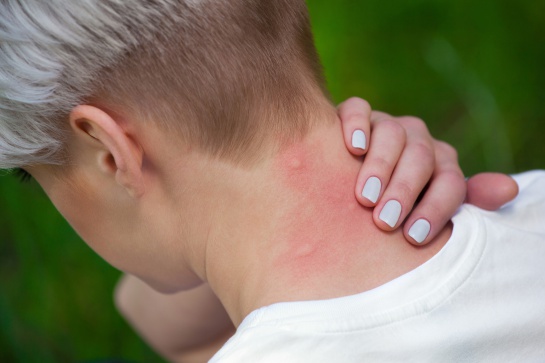 Científico explica por qué los mosquitos solo pican a algunas personas Científico explica por qué los mosquitos solo pican a algunas personas