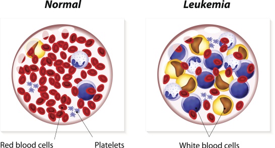 Existen factores genéticos que influyen en las causas de la leucemia (sobre todo en niños) Existen factores genéticos que influyen en las causas de la leucemia (sobre todo en niños)