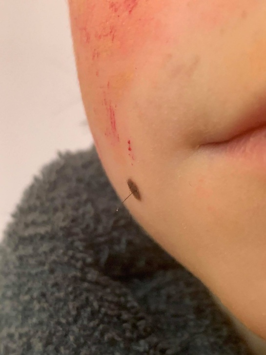 La peuqeña se tomó el tiempo para tener pelo feo en el lunar de su cachete y la uniceja La peuqeña se tomó el tiempo para tener pelo feo en el lunar de su cachete y la uniceja