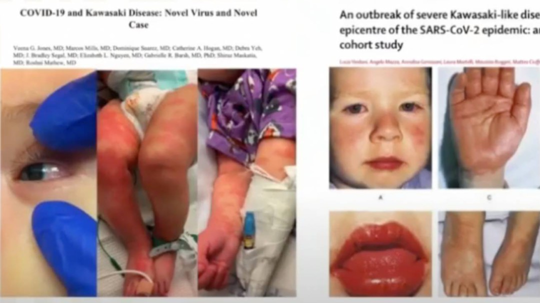 Alertan por síntomas de Kawasaki en niños con COVID-19
