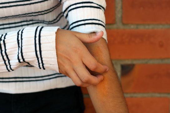 Se le conoce también como eczemas a los trastornos provocados por la inflamación de las capas superiores de la piel Se le conoce también como eczemas a los trastornos provocados por la inflamación de las capas superiores de la piel