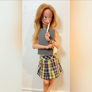 Fallece Adalia Rose, quien inspiró la cinta de Benjamin Button Fallece Adalia Rose, quien inspiró la cinta de Benjamin Button