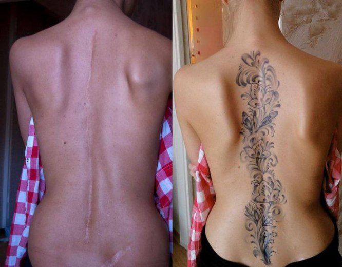 Convierten sus cicatrices en hermosos tatuajes
